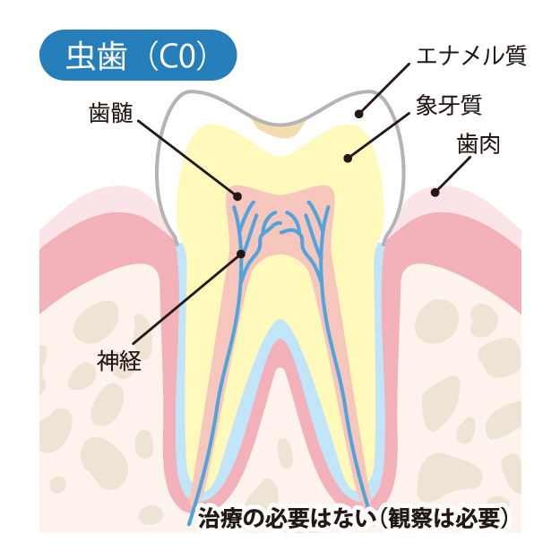 小宮歯科医院｜薬園台（船橋市）の歯医者、小宮歯科医院の精密むし歯治療