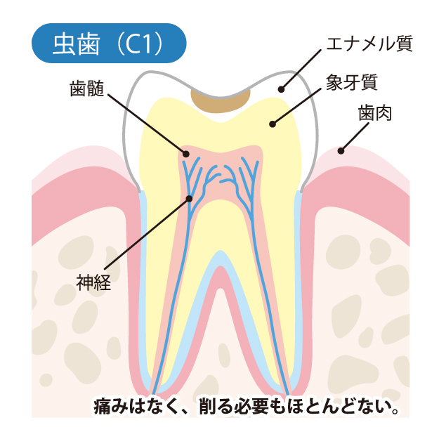 小宮歯科医院｜薬園台（船橋市）の歯医者、小宮歯科医院の精密むし歯治療