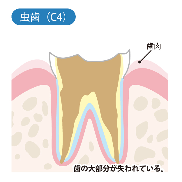 小宮歯科医院｜薬園台（船橋市）の歯医者、小宮歯科医院の精密むし歯治療