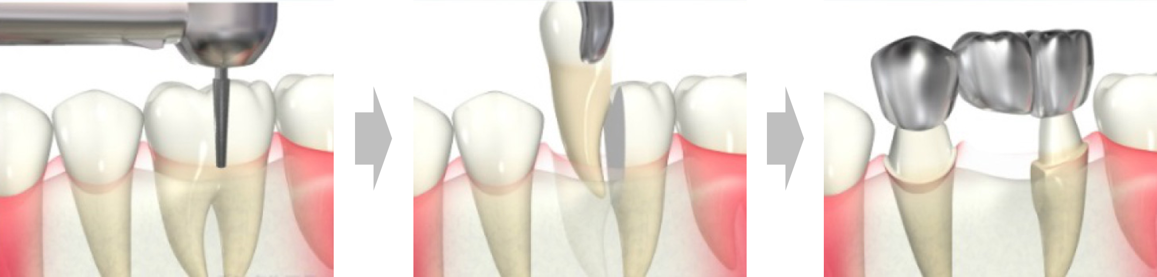 小宮歯科医院｜薬園台（船橋市）の歯医者、小宮歯科医院の精密根管治療