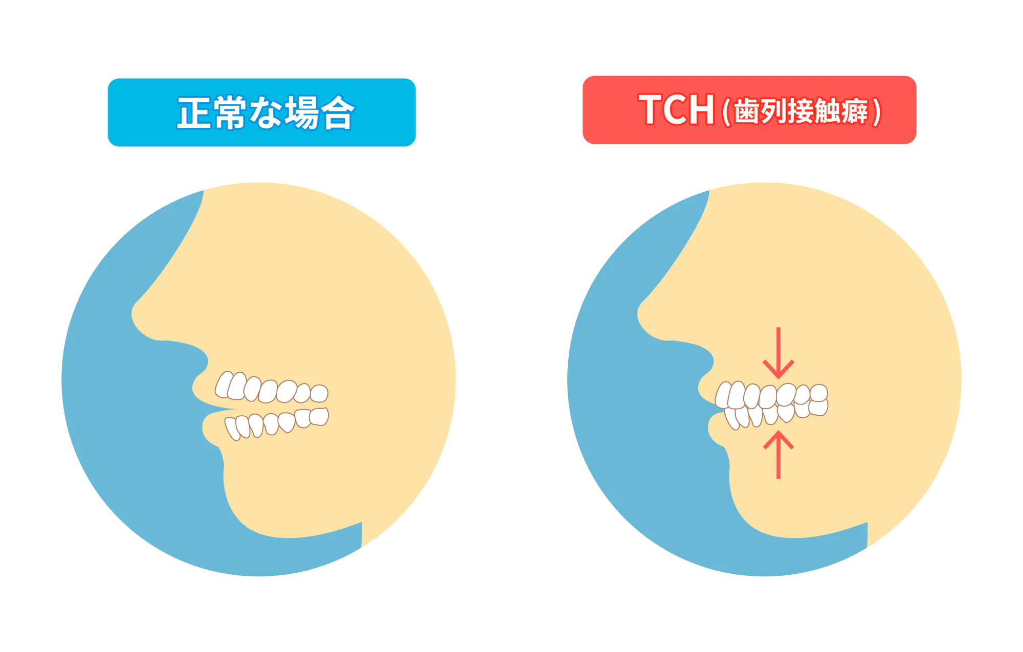 小宮歯科医院｜薬園台（船橋市）の歯医者、小宮歯科医院の歯ぎしり、食いしばり