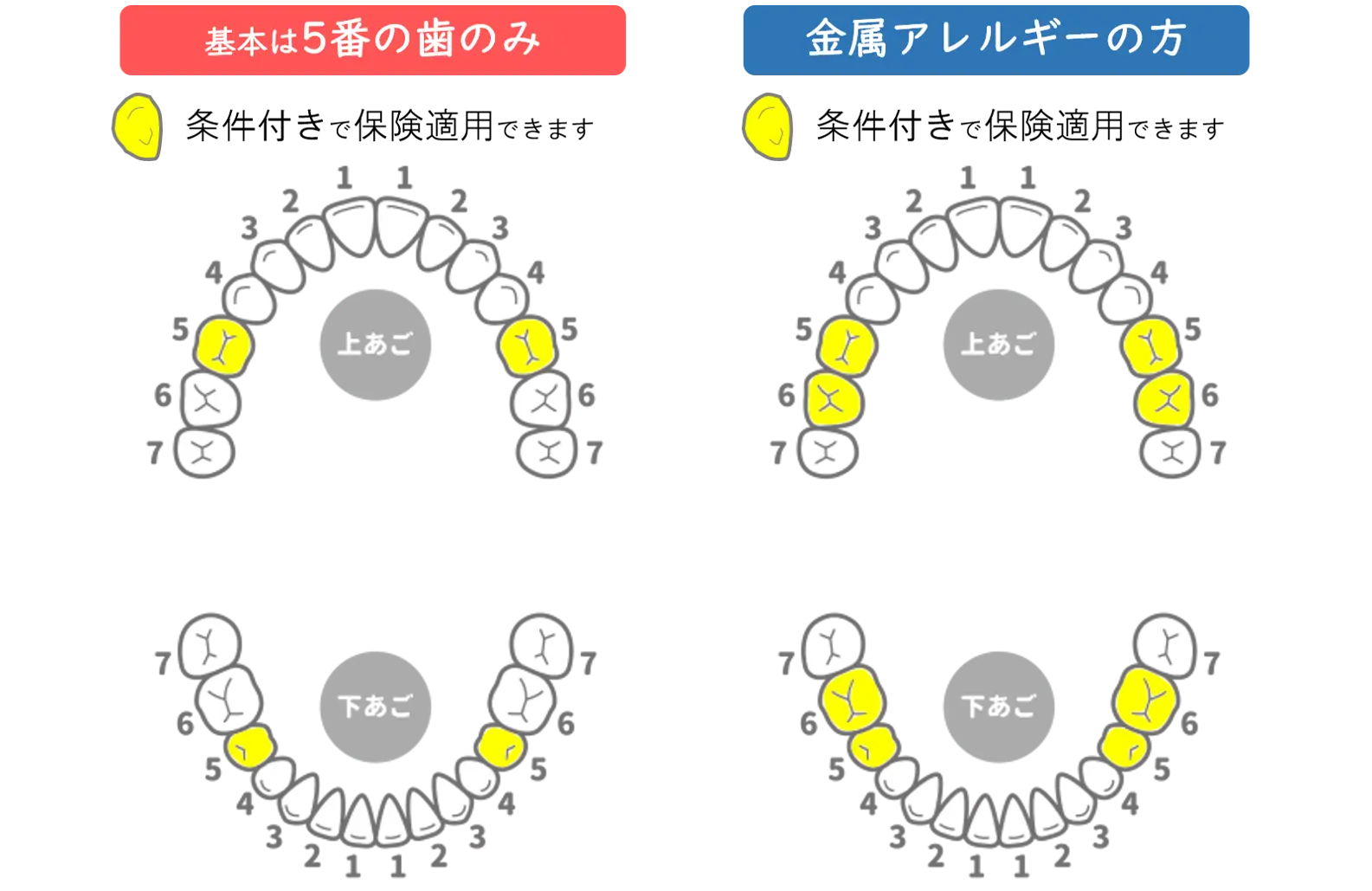 薬園台（船橋市）の歯医者、小宮歯科医院 の保険適用の白い歯